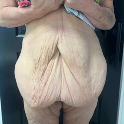 Donald Balder, MD - Before 18 lbs of lose skin was removed