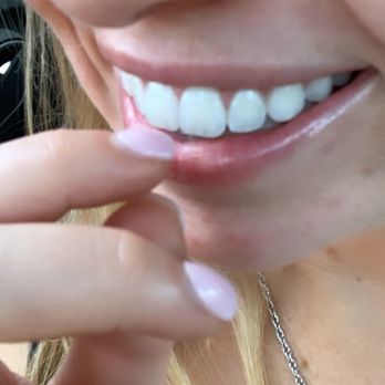Biolab Piercing Studio - Nose piercing, day 5. - Piercing Near Me - Houston, Texas Biolab Piercing Studio - Nose piercing, day 5. - Piercing Near Me - Houston, Texas