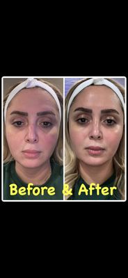 Before & After Photos - New client special 20% off a Signature Facial, Acne Facial or Microdermabrasion Facial. Book your appointment online or shoot me a text (949) 338-5685 Before & After Photos - New client special 20% off a Signature Facial, Acne Facial or Microdermabrasion Facial. Book your appointment online or shoot me a text (949) 338-5685