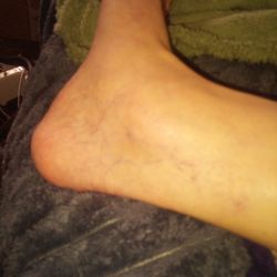 Lexington Medical Center - Arthritic joints that is my new reality courtesy of my Ortho and the dirty OR hospital.