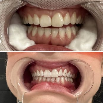 Arch Envy Studio - 1hr teeth whitening & crystal tooth gem - Teeth Whitening Near Me - Justin, Texas