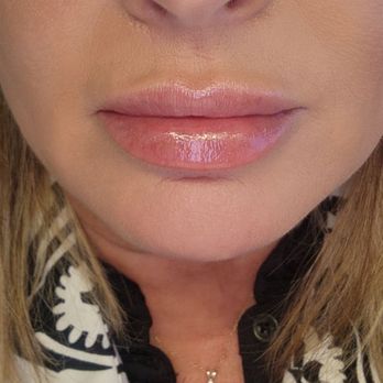 SkinDelish - Post lip pop...48 hours - Aestheticians Near Me - Glendale, Arizona