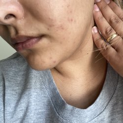 Center for Dermatology Cosmetic and Laser Surgery - This is after 4 months of acne treatments!