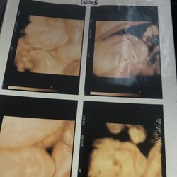 3D 4D Ultrasound by 4D Special Delivery