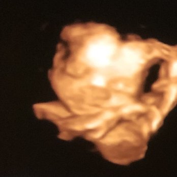 4D Miracles - My baby at 26weeks - Ultrasound Imaging Centers Near Me - Fremont, California 4D Miracles - My baby at 26weeks - Ultrasound Imaging Centers Near Me - Fremont, California