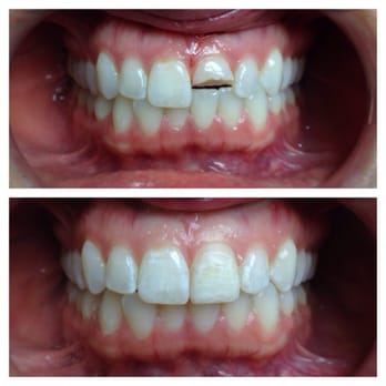 Toothopia Dental - The picture above is my cracked tooth the picture below is my original tooth glued back on. - General Dentistry Near Me - El Segundo, California Toothopia Dental - The picture above is my cracked tooth the picture below is my original tooth glued back on. - General Dentistry Near Me - El Segundo, California