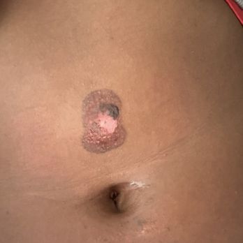 LaserAway - Blistering - Tattoo Removal Near Me - Oakland, California LaserAway - Blistering - Tattoo Removal Near Me - Oakland, California