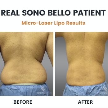 Sono Bello - Cosmetic Surgeons Near Me - Tampa, Florida Sono Bello - Cosmetic Surgeons Near Me - Tampa, Florida