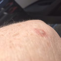 Legends Dermatology: Iulia Funieru, MD - Spot on fire arm sapped