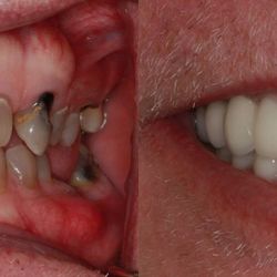 Southern Dental Implant Center - Before & After from Southern Dental Implant Center | Brentwood, TN