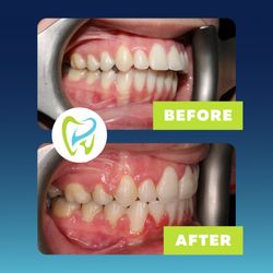 Carson Children's Dentistry - Take a look at this amazing bite correction using braces. Call us today to schedule an appointment!