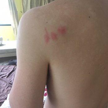 Hotel Arcata - Bed bug bites from hotel Arcata - Hotels Near Me - Arcata, California