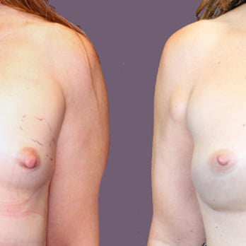 Rhee Plastic Surgery - this patient is a 38 year old woman who underwent 360 ml silicone breast implants with a periareolar incision. - Plastic Surgeons Near Me - Paramus, New Jersey