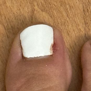 Nailtastic - Toe Infection - Nail Salons Near Me - Burbank, California Nailtastic - Toe Infection - Nail Salons Near Me - Burbank, California