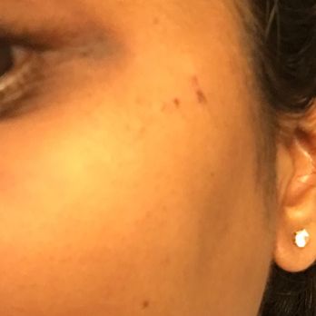 Selah Threading & Salon - The lady at parlour peeled off my skin - Waxing Near Me - Lilburn, Georgia