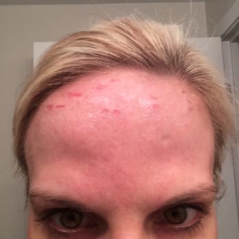 iBeauty Clinic - Burned! - Skin Care Near Me - Chicago, Illinois iBeauty Clinic - Burned! - Skin Care Near Me - Chicago, Illinois