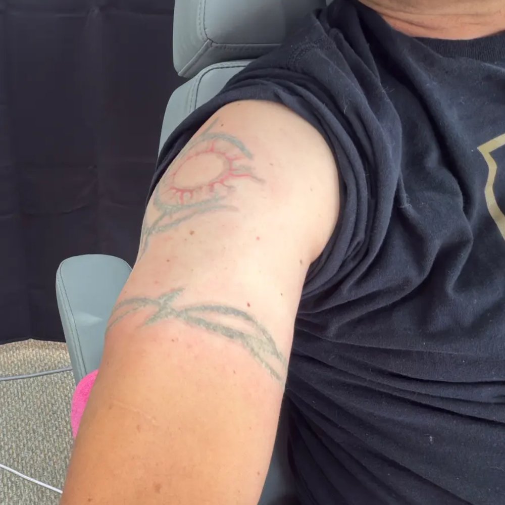 Inkless Tattoo Removal - Freshly frosted ink - Tattoo Removal Near Me - Lakewood, Colorado