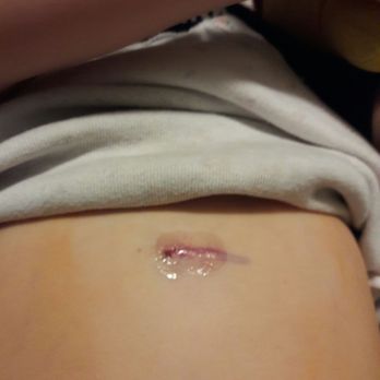 Pediatric Surgical Associates - Small incision that was glued shut. Toddler doesn't even know it's there! - Pediatricians Near Me - Orange, California Pediatric Surgical Associates - Small incision that was glued shut. Toddler doesn't even know it's there! - Pediatricians Near Me - Orange, California