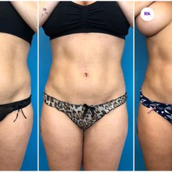Roy Kim, MD - This patient is pictured before surgery, 3 weeks post op, and 2 months post op from 360 liposuction, lipo of inner/outer thighs