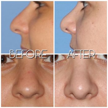 Kevin Sadati - Dr. Sadati's Office's pictures before and after my alleged ruined rhinoplasty with him. - Cosmetic Surgeons Near Me - Newport Beach, California