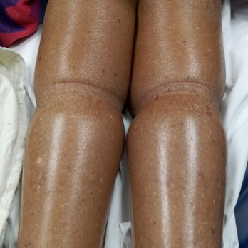 Grace Point Place - Her legs in the ER.  She had a banged up eye but she also had socks pulled all the way up on these swollen legs! - Assisted Living Facilities Near Me - Oak Lawn, Illinois
