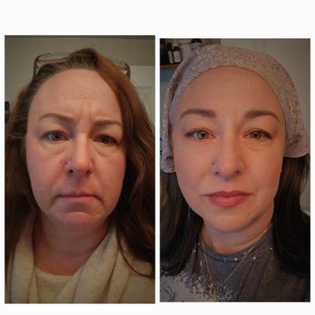 Guy Cappuccino, MD - Botox and filler results: patient submitted - Plastic Surgeons Near Me - Mount Airy, Maryland Guy Cappuccino, MD - Botox and filler results: patient submitted - Plastic Surgeons Near Me - Mount Airy, Maryland
