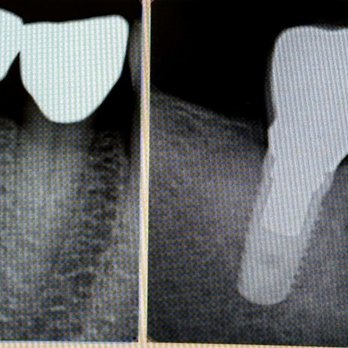 Irvine Endodontics - Root Canal. Before and after- microscopic excellence! NO PAIN! - Endodontists Near Me - Irvine, California