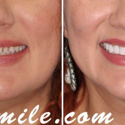 Cosmetic Dental Associates - Medical Center - Prepless Veneers