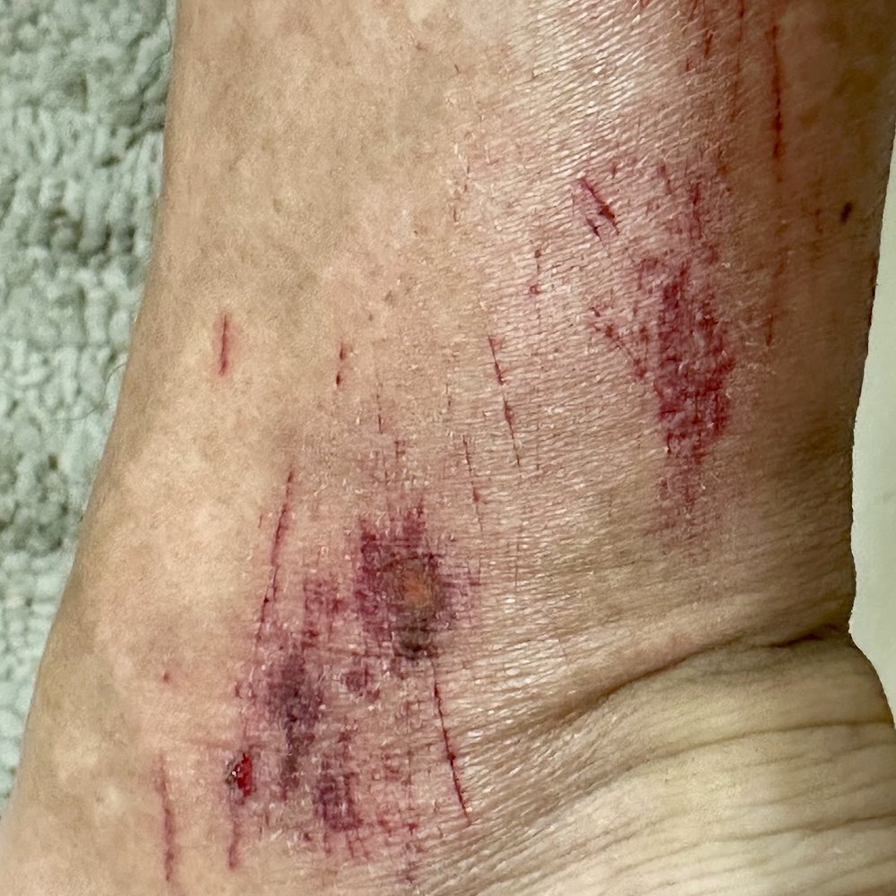 Dash Nail Spa - Extensive injuries caused by Dash Nail Spa - Nail Salons Near Me - Frisco, Texas