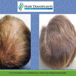 Hair Transplants of Florida - Weston
