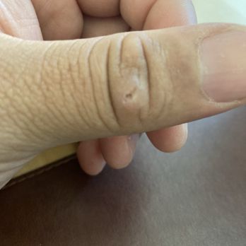 Salar Hazany MD - 1 week after. Still healing. - Dermatologists Near Me - Beverly Hills, California Salar Hazany MD - 1 week after. Still healing. - Dermatologists Near Me - Beverly Hills, California