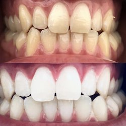 Diamond Dental Hygiene - Whiten 7-10 shades in one session!