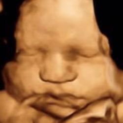 Sweet Pea 3D/4D Ultrasound - 3D