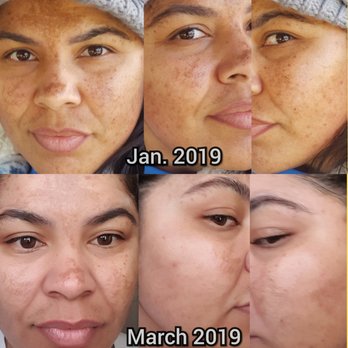 Mel's Skinspa Ink - IS pigmentation lightener day & night product recommend by Melissa. It works! - Skin Care Near Me - Orange, California Mel's Skinspa Ink - IS pigmentation lightener day & night product recommend by Melissa. It works! - Skin Care Near Me - Orange, California