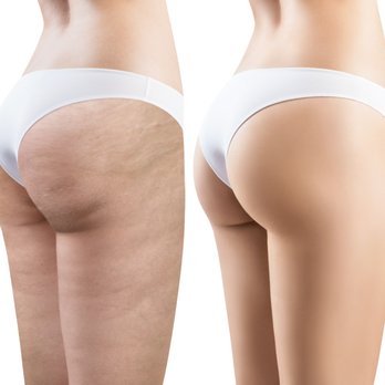 Slender Body & Mind - Cellulite Reduction - Body Contouring Near Me - Seattle, Washington Slender Body & Mind - Cellulite Reduction - Body Contouring Near Me - Seattle, Washington