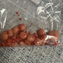 Bladder stones
