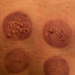 Kern David - Grace Health Center - Dr. David Kern, ND, Maui Hi *I Do Not Recommend! This is from his cupping, Second Degree Burns! and Scarring!
