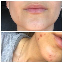 Cami's European Skin Care - The top photo is a few weeks after my facial- the bottom is before
