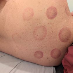 Sunrise Acupuncture Clinic - Cupping for diagnosis.