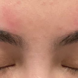 Rash caused by the thread