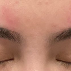 Zaine Threading Salon - Rash caused by the thread