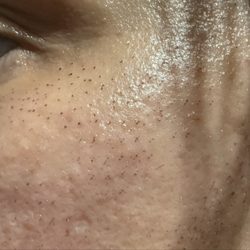 Side upper cheek