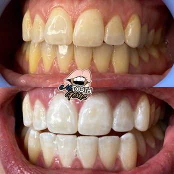 M’s Tooth Gems - First round of whitening - Teeth Whitening Near Me - University Place, Washington M’s Tooth Gems - First round of whitening - Teeth Whitening Near Me - University Place, Washington
