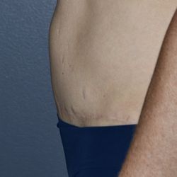 Richard A. Bartlett, MD - BEFORE: Scar he said he would correct--should have declined surgical approach for less invasive correction.