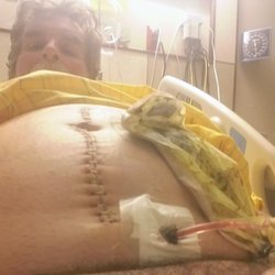 Robert T Rowland MD - UC Health - After my surgery the first time....scary stuff