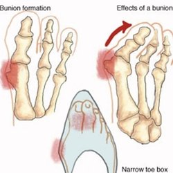 Emily Chau, DPM - Let us help you with your bunion and foot pain.