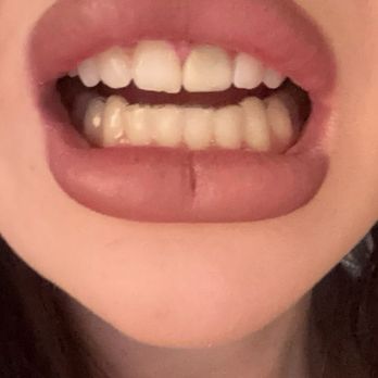 SmileStyle Dental Studio - Front right tooth done my doctor Kerry - General Dentistry Near Me - San Diego, California SmileStyle Dental Studio - Front right tooth done my doctor Kerry - General Dentistry Near Me - San Diego, California