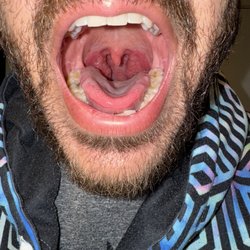 Tonsils are still swollen and they refused to help me out even after paying.