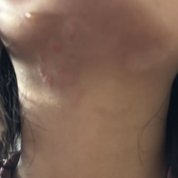 Nikhar Threading Salon - My skin/under my jawline after using aloe vera, it was dry and bleeding really bad before! - Skin Care Near Me - Anaheim, California