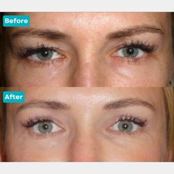 Christopher C. Lo, MD - Los Angeles - This patient underwent an upper blepharoplasty by Dr. Lo for a more youthful and rejuvenated appearance